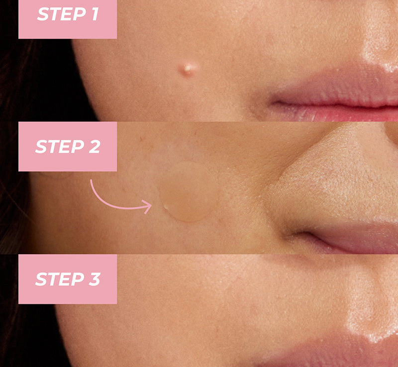 MIRACLE PIMPLE PATCHES